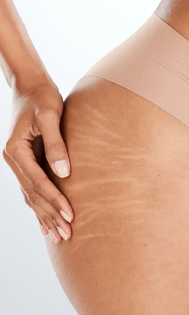 ¿Qué es el tratamiento para <em>quitar estías</em>?