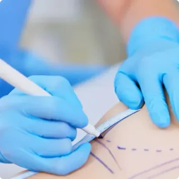 ¿Qué implica una <em>reducción mamaria</em> en IdB?