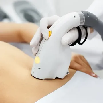 quitar estrias en consulta