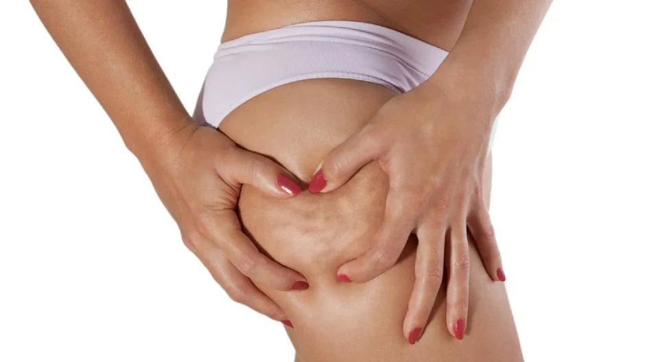 Pre y post tratamiento de <em>Body Slim</em>