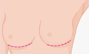 Aumento de pecho por vía submamaria