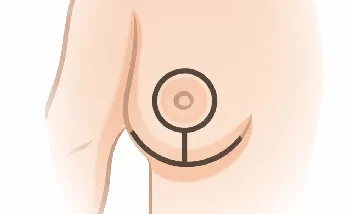 T invertida en reducción mamaria