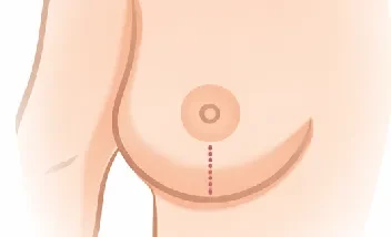 reducción t vertical