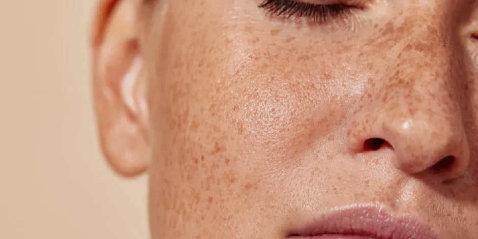 ¿Por qué nos salen manchas en la piel?